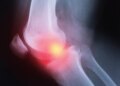 Do Osteoarthritis Treatments Actually Work? New Study Questions Efficacy