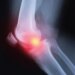 Do Osteoarthritis Treatments Actually Work? New Study Questions Efficacy