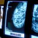 Health leaders welcome new UK cancer targets but warn more ‘resources’ needed