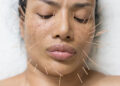 How Cosmetic Acupuncture Offers the Ultimate Glow Up
