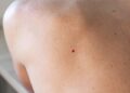 Red Moles on Skin: Causes, Removal, and When to See a Doctor
