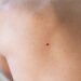 Red Moles on Skin: Causes, Removal, and When to See a Doctor