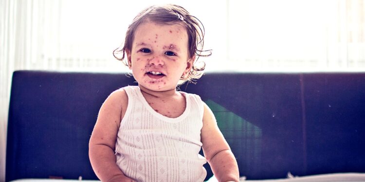 What you should know about rising measles cases