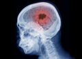 New Research Links Popular Hormone Drugs to Brain Tumors