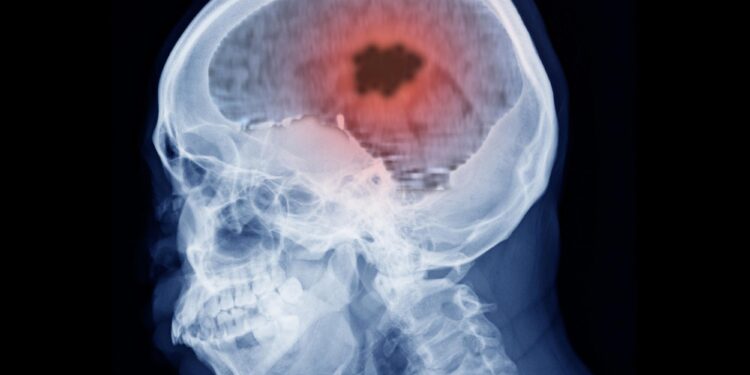 New Research Links Popular Hormone Drugs to Brain Tumors