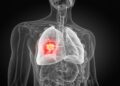 Why Lung Cancer Treatments Often Fail in Non-Smokers