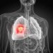 Why Lung Cancer Treatments Often Fail in Non-Smokers