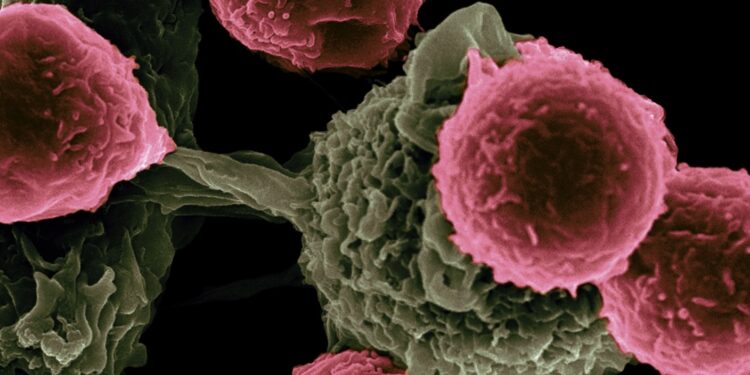 Autoimmune Diseases Stopped in Their Tracks by ‘Phenomenal’ Donor Cell Therapy