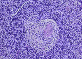 First in 45 Years: Scientists Discover New Subtype of Castleman Disease