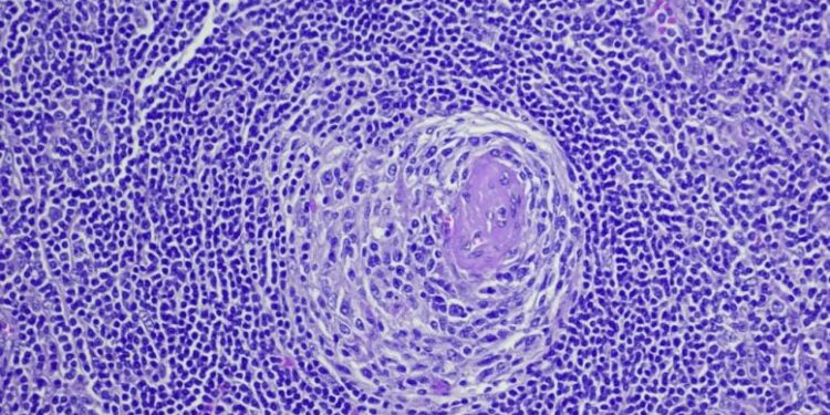 First in 45 Years: Scientists Discover New Subtype of Castleman Disease