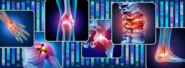 $486 Billion Problem: Groundbreaking Study Could Slash Osteoarthritis Costs