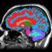 This MRI Reads Your Brain’s Hidden Clock and Predicts Dementia Decades Ahead