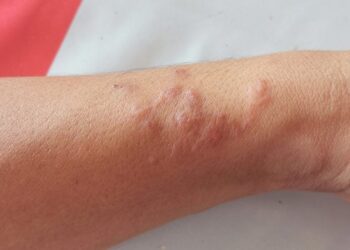 This Parasitic Worm Can Turn Off Your Pain and Itch Sensors