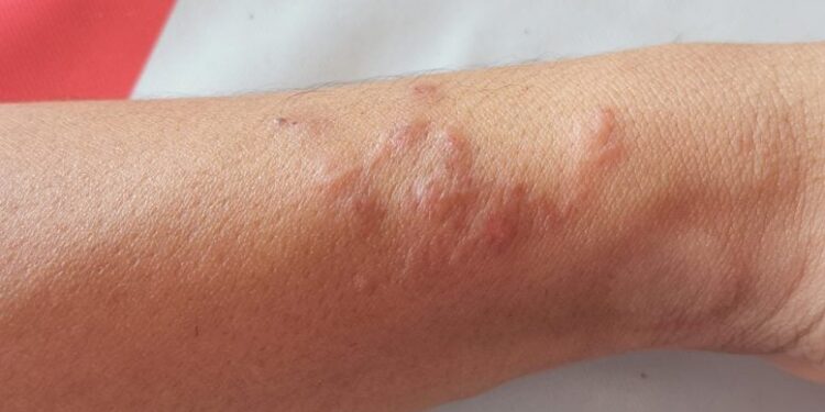 This Parasitic Worm Can Turn Off Your Pain and Itch Sensors