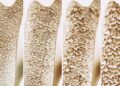 The Newly Found Bone Switch That Could Stop Osteoporosis