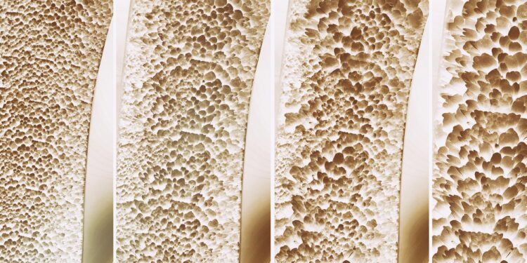 The Newly Found Bone Switch That Could Stop Osteoporosis