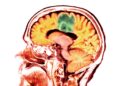 Traumatic brain injury ups risk for brain cancer
