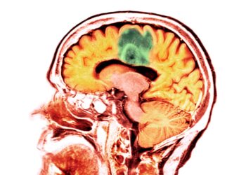 Traumatic brain injury ups risk for brain cancer