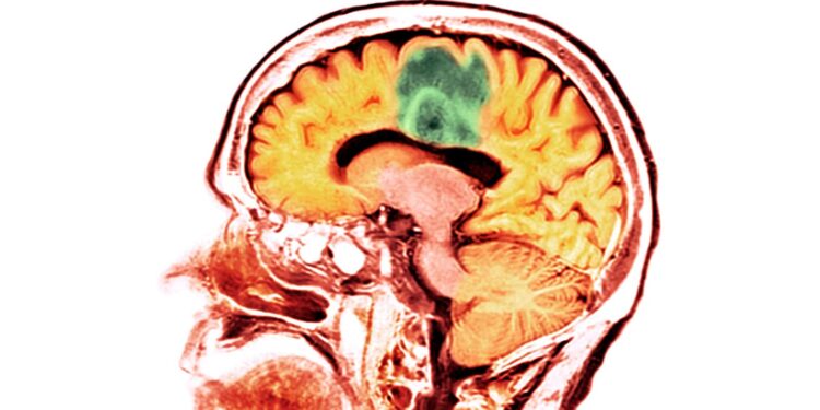 Traumatic brain injury ups risk for brain cancer