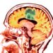 Traumatic brain injury ups risk for brain cancer