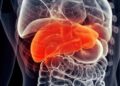Existing Drugs Combine To Fight World’s Most Common Liver Disease