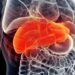 Existing Drugs Combine To Fight World’s Most Common Liver Disease