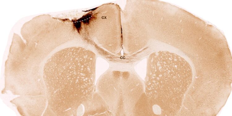Stroke Damage Reversed As Stem Cells Regrow the Brain