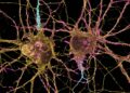 A New Approach Could Transform Huntington’s Disease Treatment
