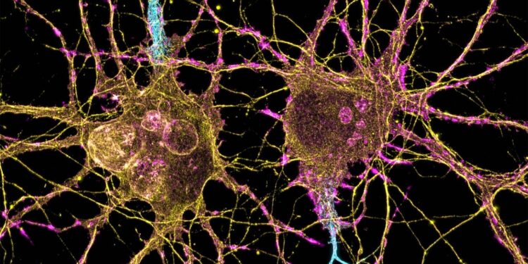 A New Approach Could Transform Huntington’s Disease Treatment