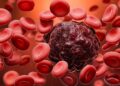 AI Blood Cell Analyzer Outperforms Human Experts in Detecting Leukemia