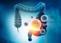The Immune Chain Reaction That Raises Colon Cancer Risk in IBD