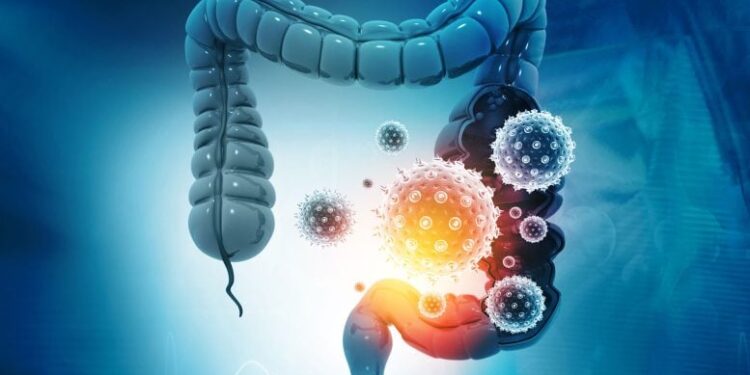 The Immune Chain Reaction That Raises Colon Cancer Risk in IBD