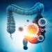 The Immune Chain Reaction That Raises Colon Cancer Risk in IBD