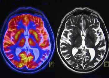 Brain Scans Reveal Hidden Changes After Menopause