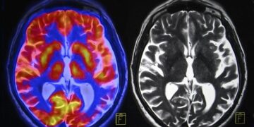 Brain Scans Reveal Hidden Changes After Menopause