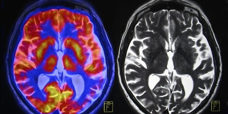 Brain Scans Reveal Hidden Changes After Menopause