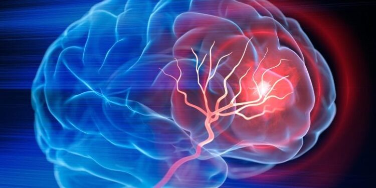 Scientists Develop IV Therapy That Repairs the Brain After Stroke