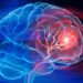 Scientists Develop IV Therapy That Repairs the Brain After Stroke