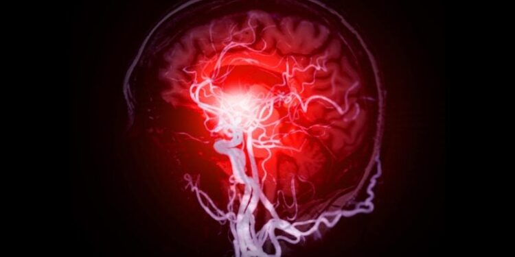 Tiny Clots Could Be the Missing Piece in Alzheimer’s Puzzle