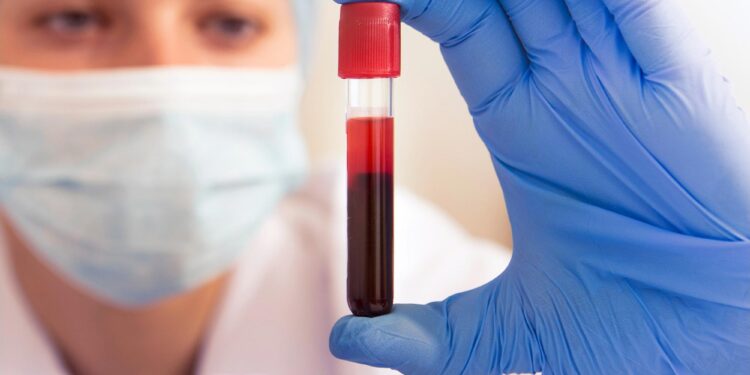 Simple Blood Test May Predict Alzheimer’s Years Before Brain Scans Show Signs