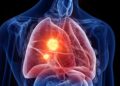 Marijuana Use May Raise Lung Cancer Risk, Researchers Warn