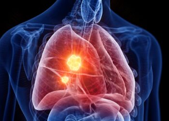 Marijuana Use May Raise Lung Cancer Risk, Researchers Warn