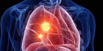Marijuana Use May Raise Lung Cancer Risk, Researchers Warn