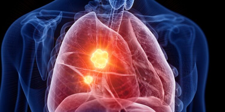 Marijuana Use May Raise Lung Cancer Risk, Researchers Warn