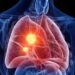 Marijuana Use May Raise Lung Cancer Risk, Researchers Warn