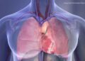 Common Mouth Bacteria May Trigger Dangerous Calcium Buildup in the Heart