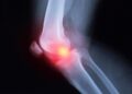 Why Arthritis Can Come Back Stronger After Cancer Immunotherapy