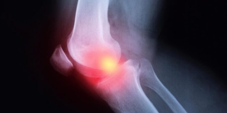 Why Arthritis Can Come Back Stronger After Cancer Immunotherapy
