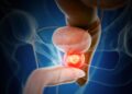 New Drug Combination Shows Promise Against Advanced Prostate Cancer