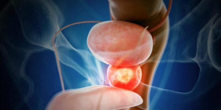 New Drug Combination Shows Promise Against Advanced Prostate Cancer